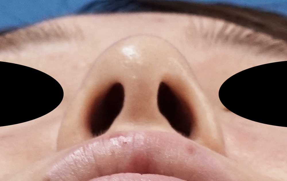 鼻尖縮小、軟骨移植、ストラット　６ヶ月後　下からのBefore写真