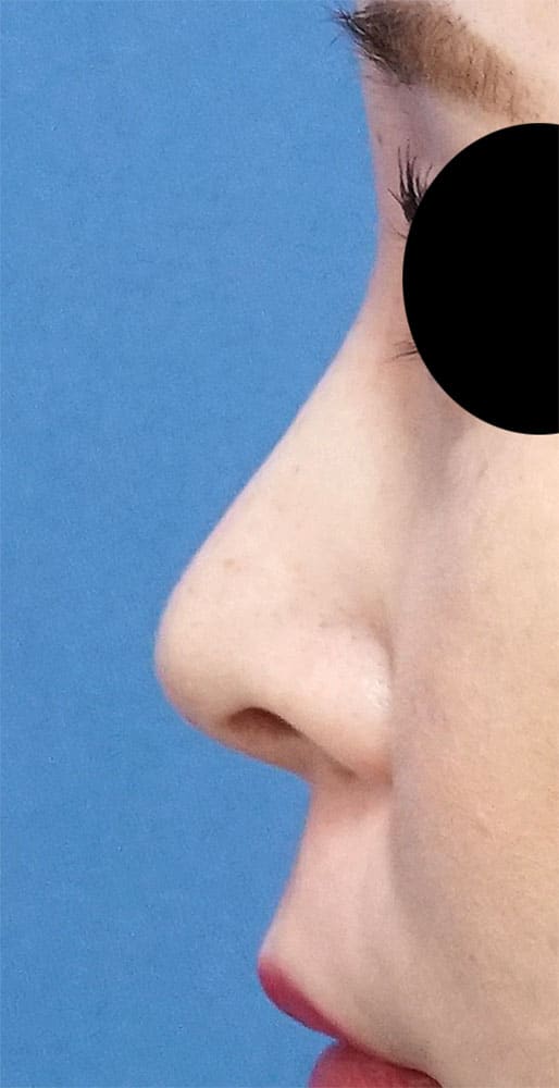 鼻尖縮小、軟骨移植、ストラット 6ヶ月後 左側面のAfterの写真