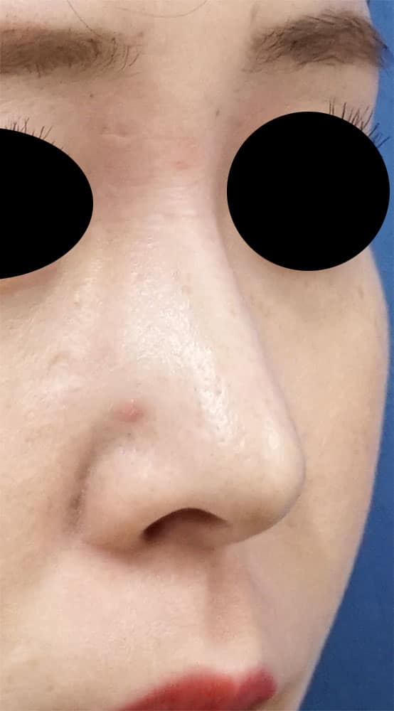 鼻尖縮小、軟骨移植、ストラット　６ヶ月後　右斜めのAfterの写真