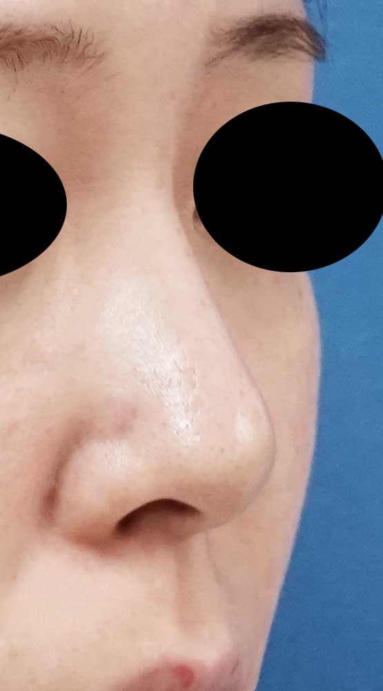 鼻尖縮小、軟骨移植、ストラット　６ヶ月後　右斜めのBefore写真