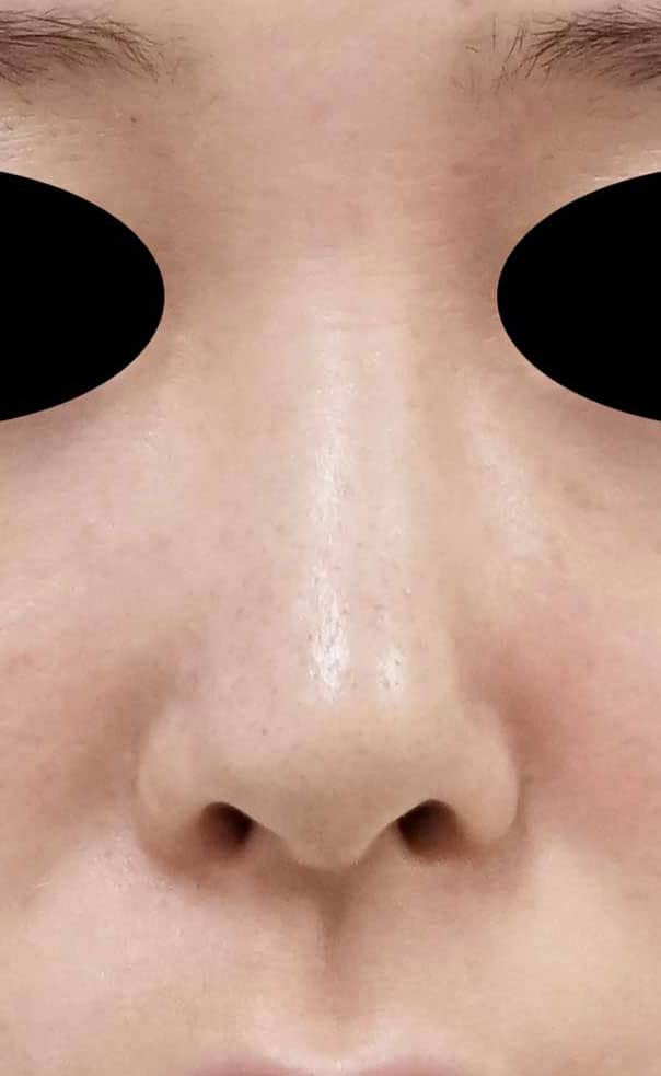 鼻尖縮小、軟骨移植、ストラット 6ヶ月後 正面のBefore写真