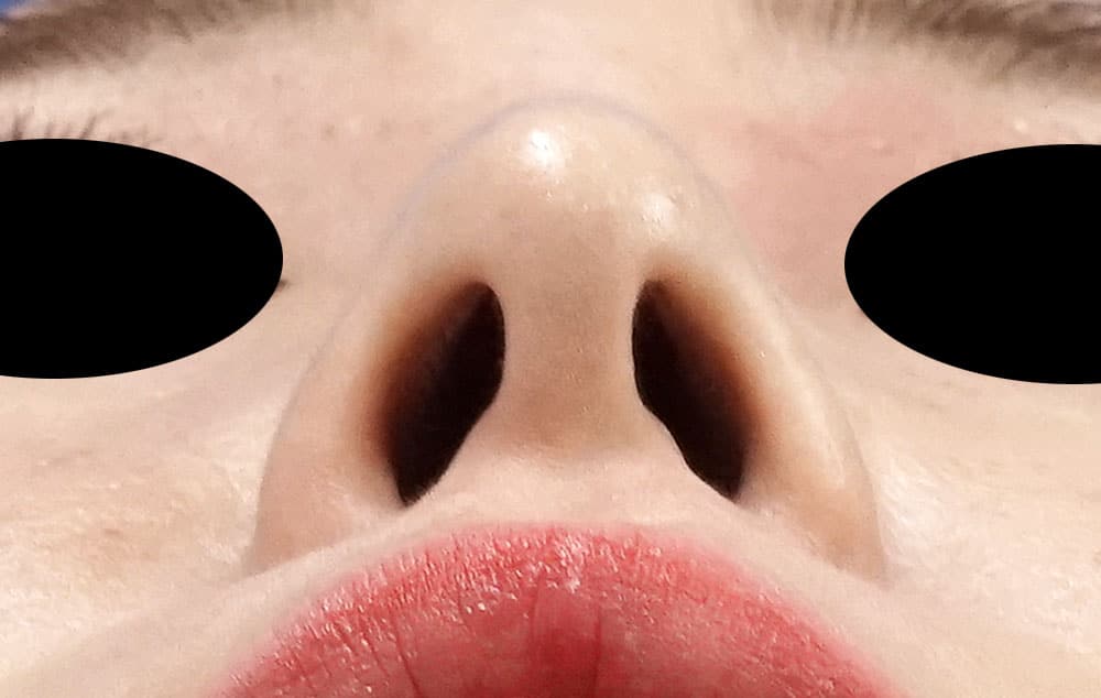 鼻尖縮小、軟骨移植、ストラット　６ヶ月後　下からのAfterの写真