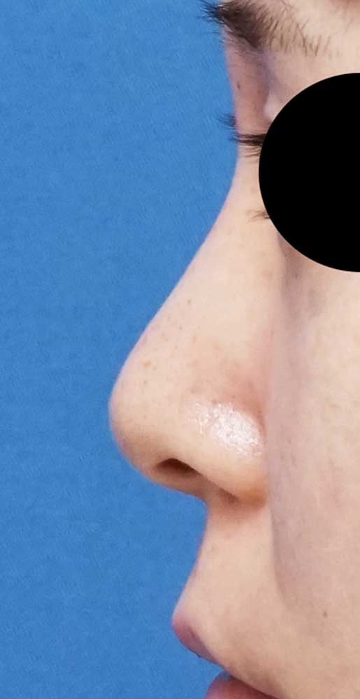 鼻尖縮小、軟骨移植、ストラット 6ヶ月後 左側面のBefore写真