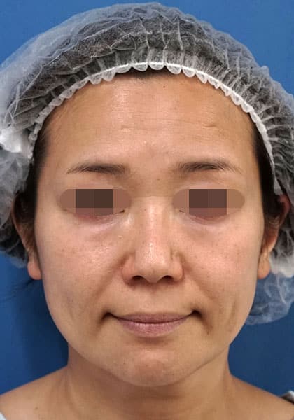 目の下のクマ取り(脂肪とり+脂肪注入)としわ治療(ほうれい線・口角脂肪注入) 6ヶ月後のBefore写真
