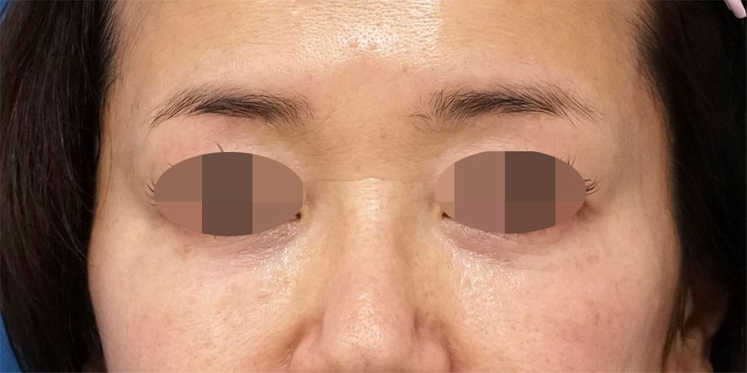 目の下脂肪とり＋脂肪注入（目の下）　６ヶ月後のAfterの写真