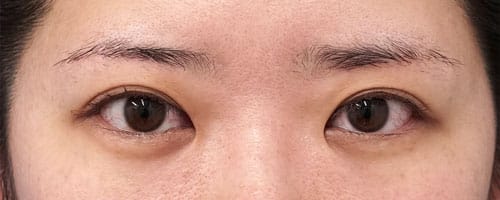 眉下切開術　６ヶ月後のAfterの写真