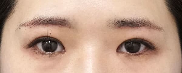 眉下切開、目頭切開（リドレープ）、二重埋没法（もとびアイゴールド）、厚み取り　２ヶ月後のAfterの写真