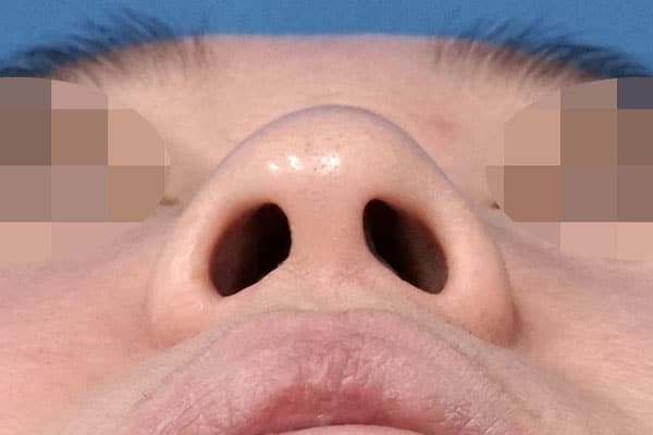 鼻尖縮小（３D法）＋ストラット、鼻柱基部下降、鼻孔縁延長　１ヶ月後　下からのBefore写真