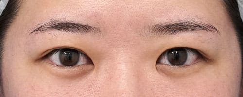 眉下切開術　６ヶ月後のBefore写真