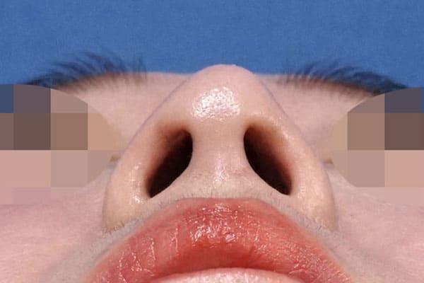 鼻尖縮小（３D法）＋ストラット、鼻柱基部下降、鼻孔縁延長　１ヶ月後　下からのAfterの写真