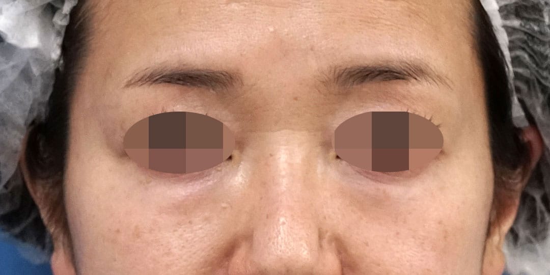 目の下脂肪とり＋脂肪注入（目の下）　６ヶ月後のBefore写真