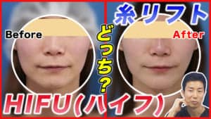 たるみ治療】糸リフトとHIFU(ハイフ)のどちらを受けるべき？