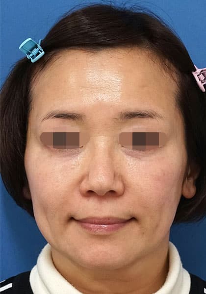 目の下のクマ取り(脂肪とり+脂肪注入)としわ治療(ほうれい線・口角脂肪注入) 6ヶ月後のAfterの写真