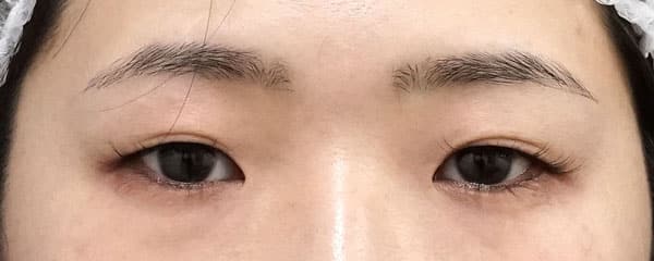 眉下切開、目頭切開（リドレープ）、二重埋没法（もとびアイゴールド）、厚み取り　２ヶ月後のBefore写真