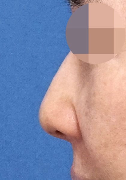 鼻尖縮小（3D法）、ストラット、耳介軟骨移植　１ヶ月後　正面のBefore写真