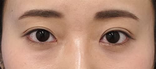 目頭切開（リドレープ法）　１ヶ月後のAfterの写真