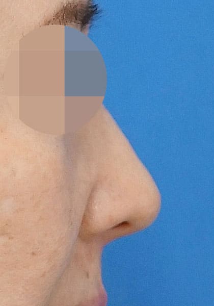 鼻尖縮小（3D法）、ストラット、耳介軟骨移植　１ヶ月後　右側面のAfterの写真