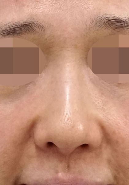 鼻尖縮小(3D法)、ストラット、耳介軟骨移植 1ヶ月後 正面のBefore写真