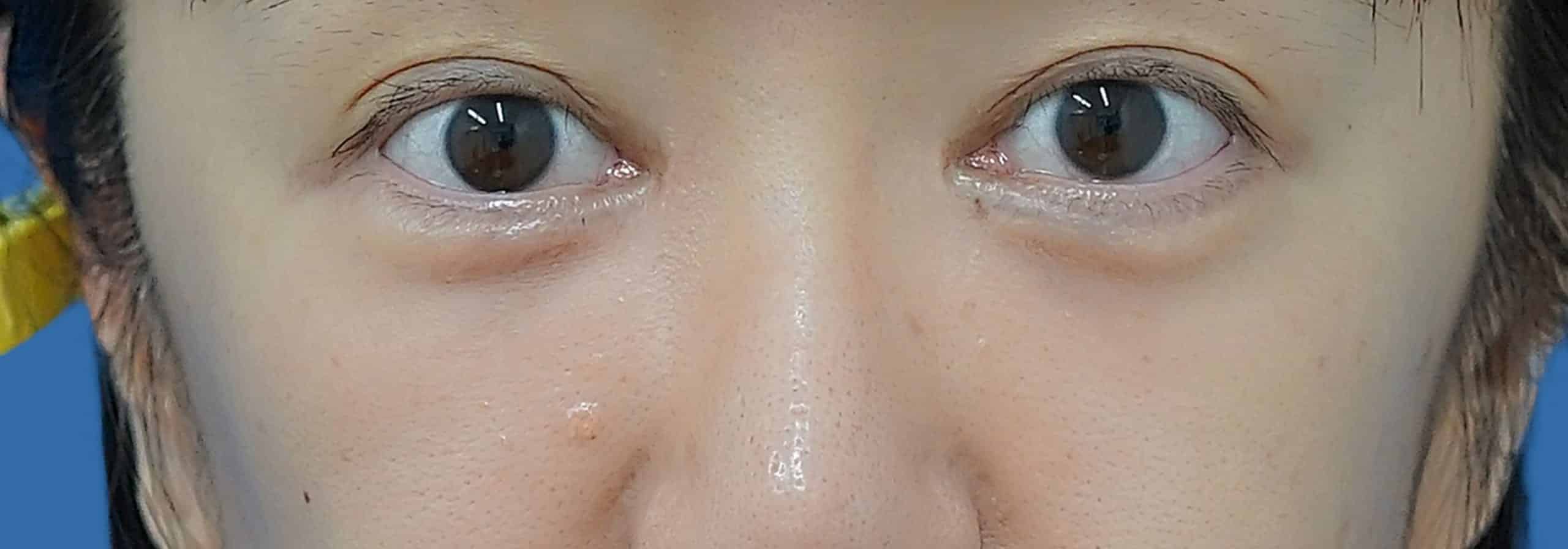 目の下の脂肪取り＋コンデンス脂肪注入 術後1か月のAfterの写真
