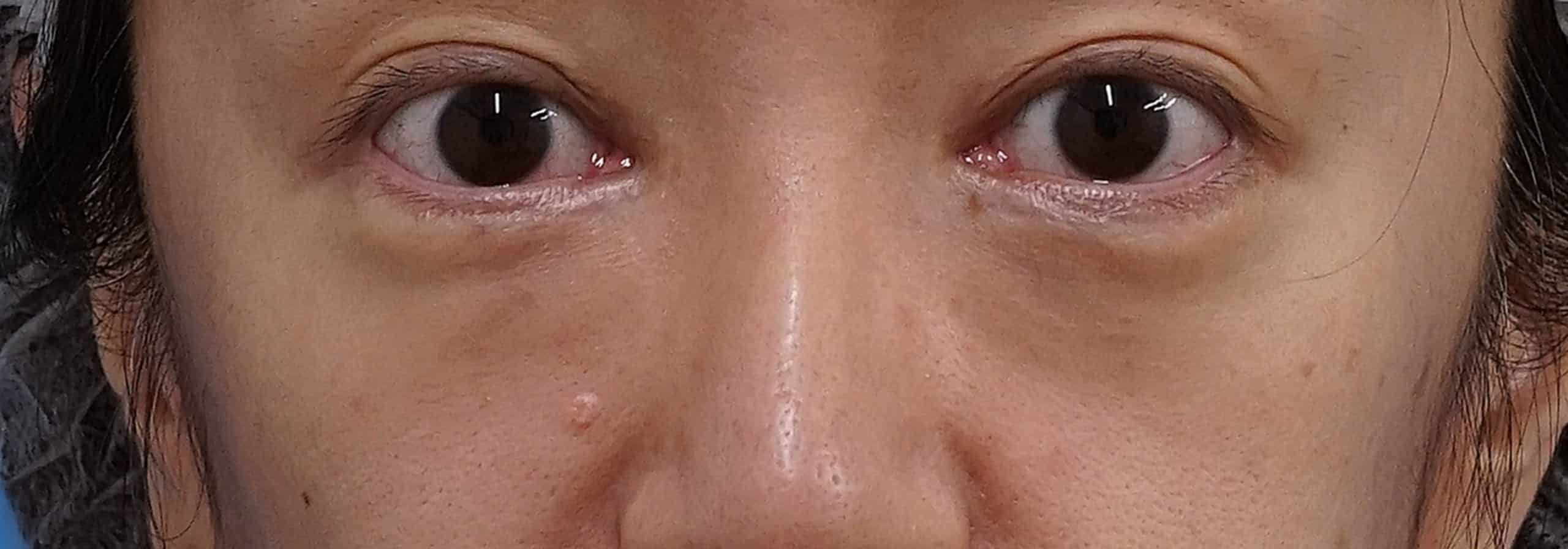 目の下の脂肪取り＋コンデンス脂肪注入 術後3か月のBefore写真