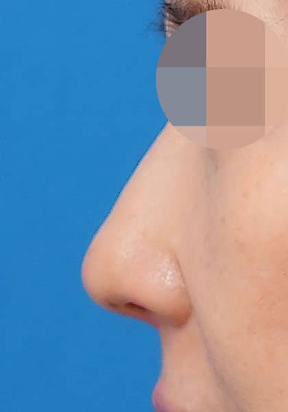 鼻尖縮小（3D法）、ストラット、耳介軟骨移植　１ヶ月後　正面のAfterの写真