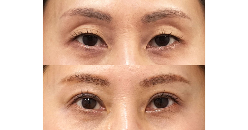 たるみもくぼみも眼瞼下垂もある方に、二重全切開、挙筋前転術（眼瞼下垂）、眼窩脂肪引き下げ　６ヶ月後