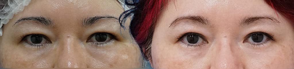 短いダウンタイムで、理想の目元へ。「切らない眼瞼下垂プレミアム」の魅力