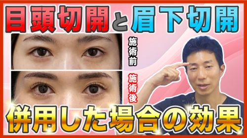 目頭切開と眉下切開を併用すると、目元の印象はどう変わるの？症例写真を用いて徹底解説