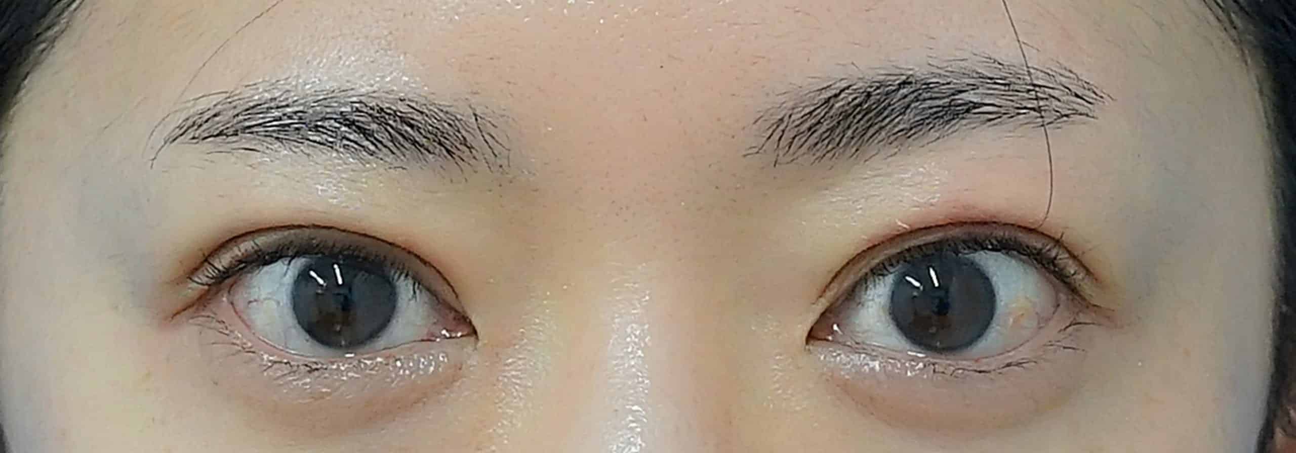二重埋没：もとびアイライト　術後1週間のAfterの写真