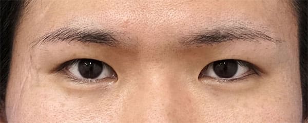 眉下切開　６ヶ月後のAfterの写真