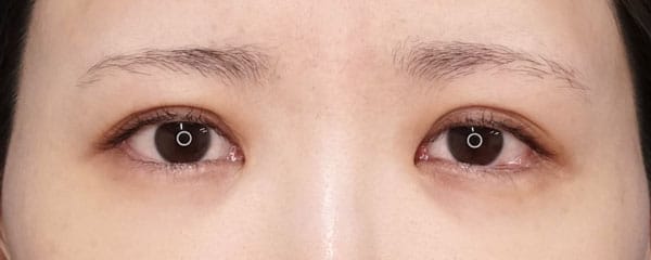 目頭切開（リドレープ法）　２年半後のBefore写真