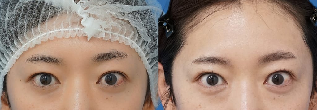 二重が一重っぽく…眉を上げて目を開けるクセを、「もとびアイライト」で解消した！
