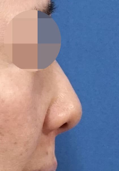 鼻尖縮小（3D法）、ストラット、耳介軟骨移植　１ヶ月後　右側面のBefore写真