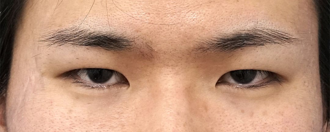 眉下切開　６ヶ月後のBefore写真
