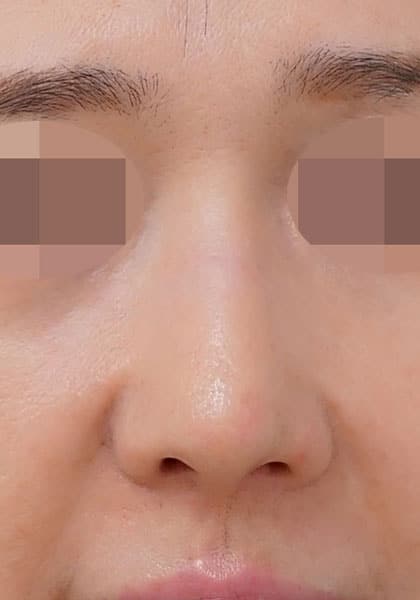 鼻尖縮小(3D法)、ストラット、耳介軟骨移植 1ヶ月後 正面のAfterの写真