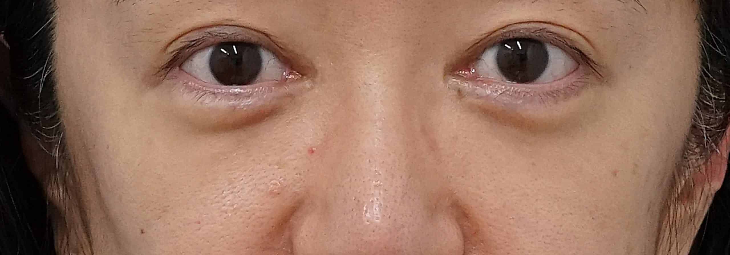 目の下の脂肪取り＋コンデンス脂肪注入 術後3か月のAfterの写真
