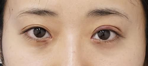目頭切開（リドレープ法）　5日後のAfterの写真