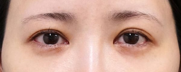 目頭切開（リドレープ法）　２年半後のAfterの写真