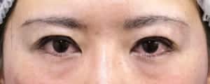 ハム目改善（睫毛側たるみ取り）手術直後