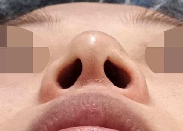 鼻尖縮小+軟骨移植+ストラット、小鼻縮小（内側＋外側）３ヶ月後　下からのBefore写真