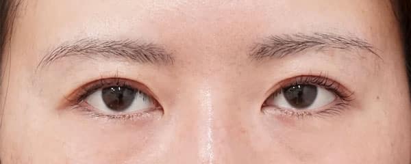 ダウンタイムの少ないハム目改善手術（睫毛側たるみ取り）　直後～１ヶ月後、閉眼ものAfterの写真