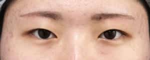 眉下切開　１ヶ月後
