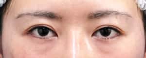 ハム目改善（睫毛側たるみ取り）手術前