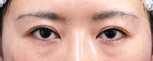 ダウンタイムの少ないハム目改善手術（睫毛側たるみ取り）　直後～１ヶ月後、閉眼ものBefore写真