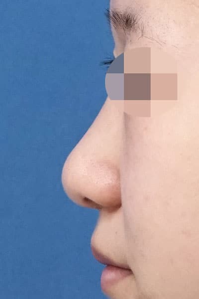 鼻尖縮小、軟骨移植、ストラット　１か月後　左側面のBefore写真