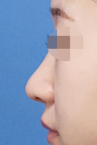 鼻尖縮小、軟骨移植、ストラット　１か月後　左側面のAfterの写真