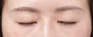 睫毛側たるみ取り（ハム目改善）　３ヶ月後　閉眼