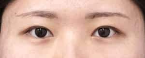 眉下切開、目頭切開Z形成Park法、二重埋没法（もとびアイゴールド）　６ヶ月後