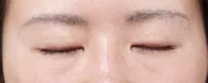 ハム目改善（睫毛側たるみ取り）１ヶ月後　閉眼