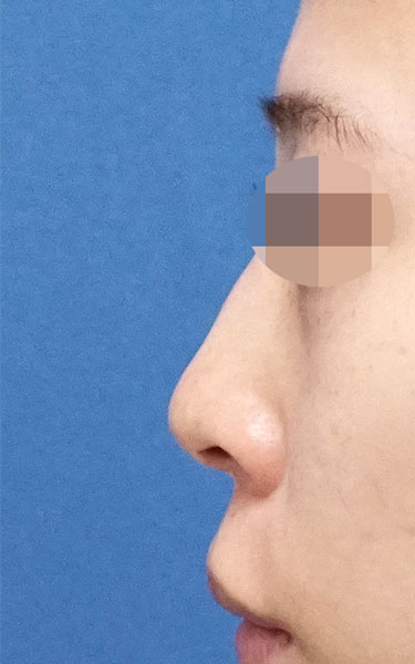 鼻尖縮小＋軟骨移植＋ストラット、鼻翼縮小（内＋外）　３ヶ月後　左側面のBefore写真